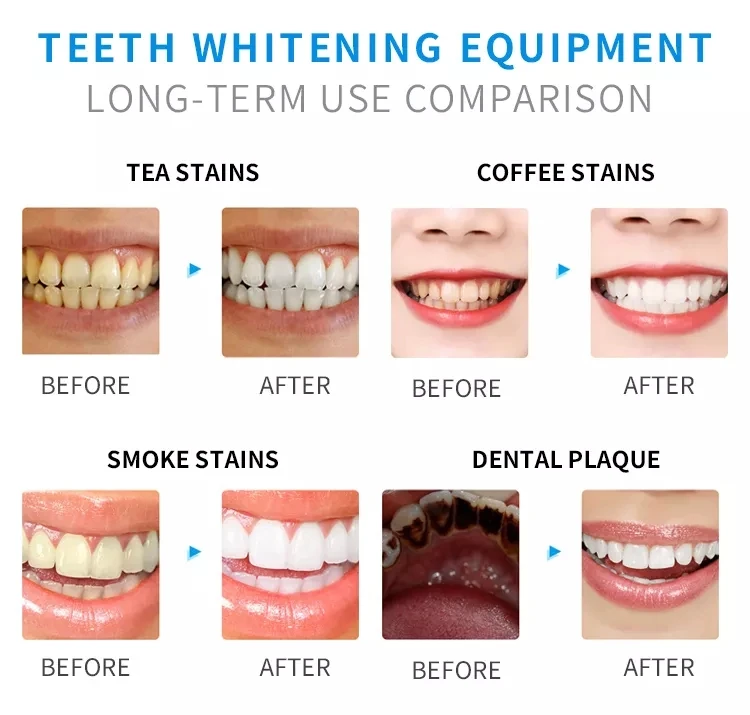 Whitening Teeth Kit Advanced Dental Teeth Whitening System Machine For