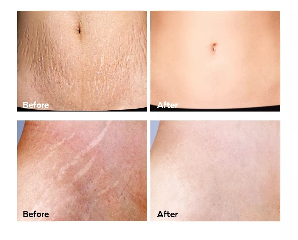 VIBRANT GLAMOUR Pregnancy Treatment Stretch Marks Cream 30g