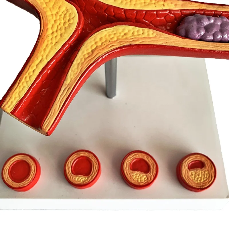 Sumo Heart Atherosclerosis And Thrombosis Model Human Heart Disease Medical Teaching Anatomical Model Buy Pathological Model Of The Blood Vessel 10 X Life Size Medical Teaching Aids Human Thrombosis Model Product On Alibaba Com