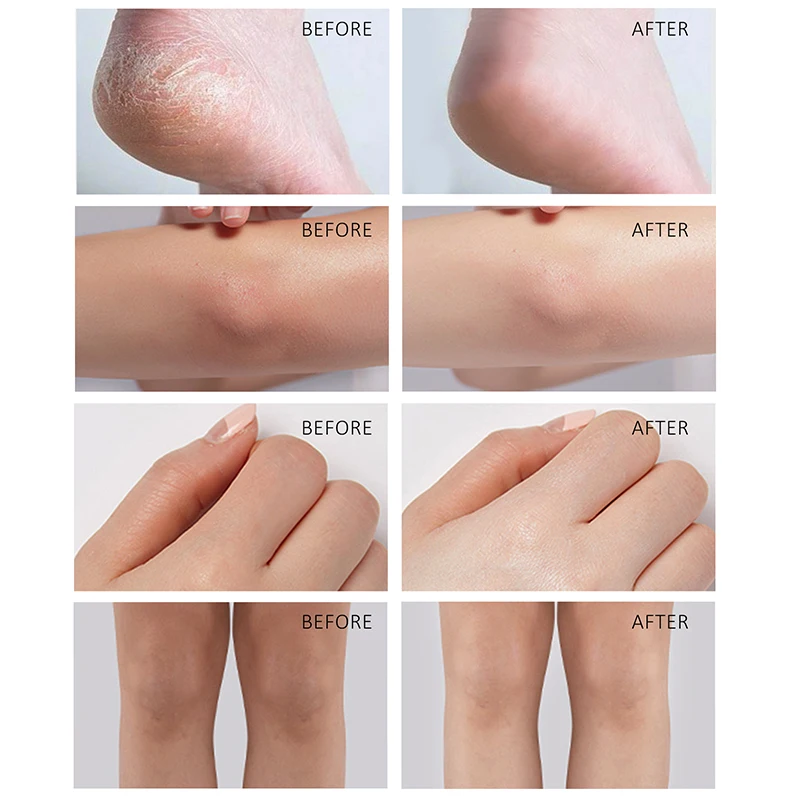 Foot Defrosting Remove Dead Skin Foot Cream for Peeling Cuticles Heel Skin  Care - Guangzhou Bonnieco Cosmetics Co., Ltd.