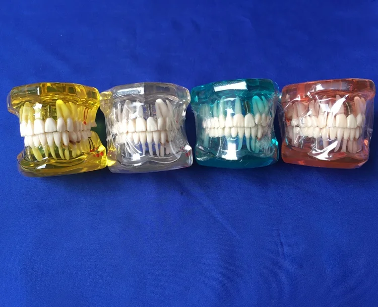 Модель для восстановления зубов с имплантатом