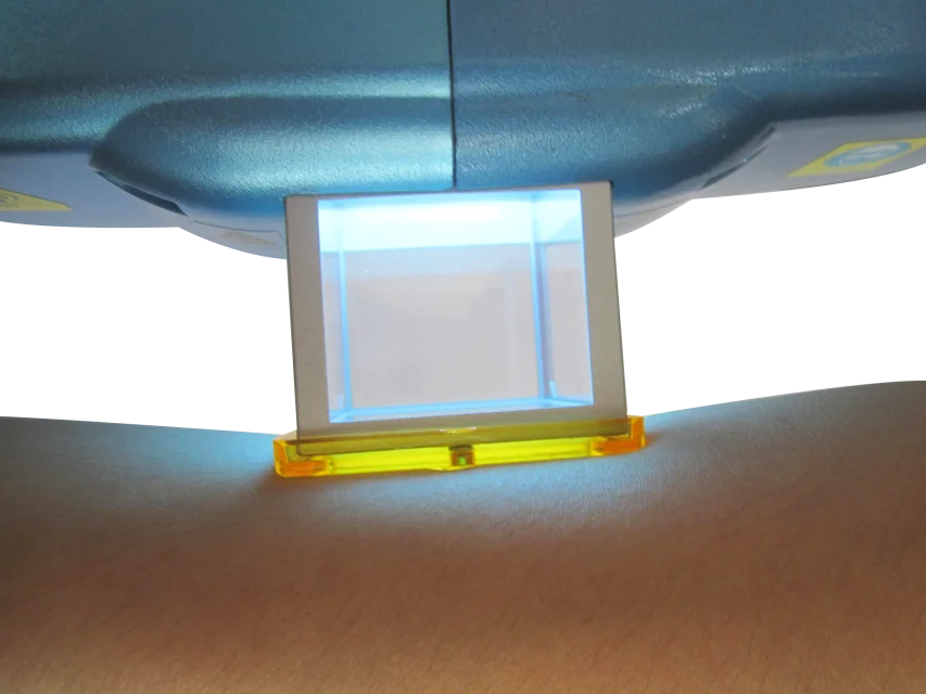 Vitiligo, псориаз, лечение дерматита, возбуждающая лазерная система Mini 308, система возбуждения, класс II 2 дня EN ISO13485