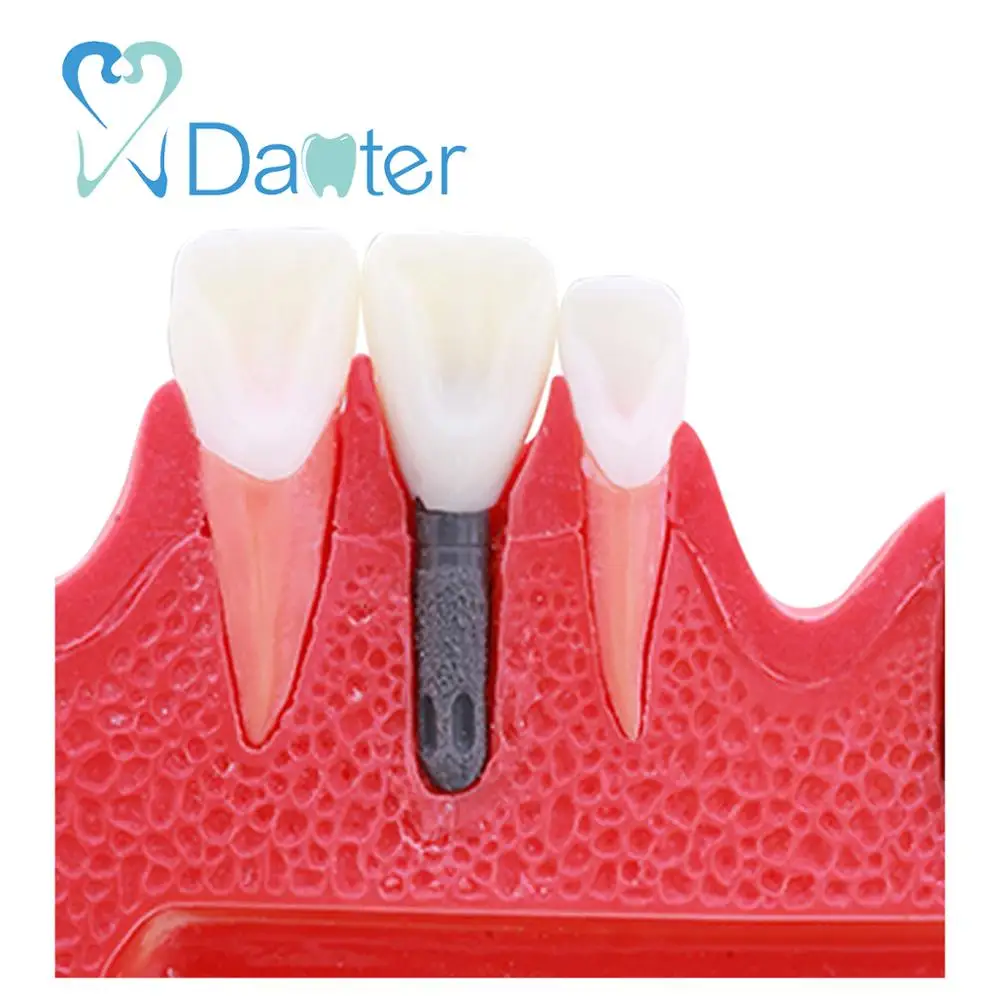 Шаг по заводской цене для имплантации стоматологической модели студенческой