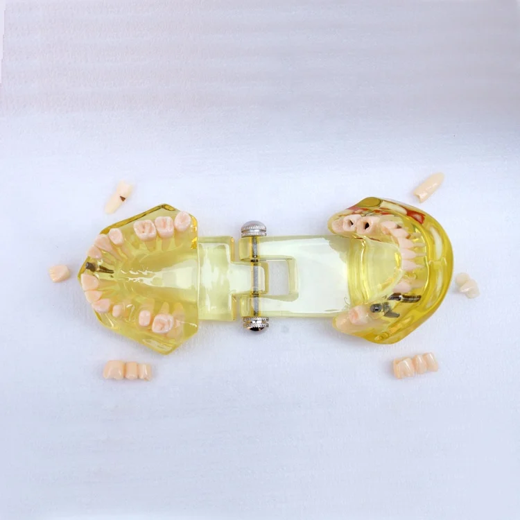 Модель для восстановления зубов с имплантатом