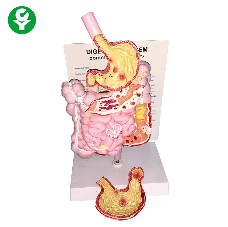 Sistema Digestivo Común Patologías Modelo Anatómico Modelo De Sistema  Digestivo - Buy Intestinal Tract Model,Gastric Model Product on 