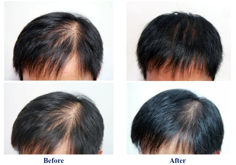 Daily Scalp Massage Hair Growth Results Natural Hair Daily Scalp Massage Hair Growth Results Natural Hair