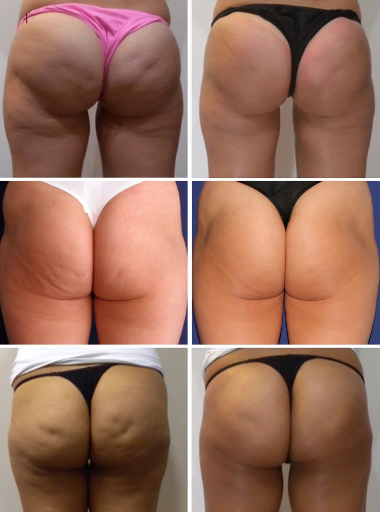 
Экстракорпоральная ударно-волновая терапия оборудование/ударно-волновая машина цена для эректильной дисфункции 