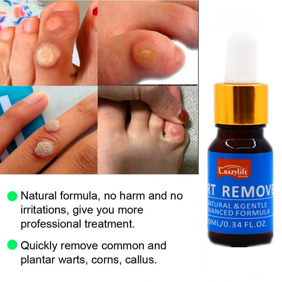 
Средство для удаления родинок, бородавок, мозолей, черных точек, 10 мл 