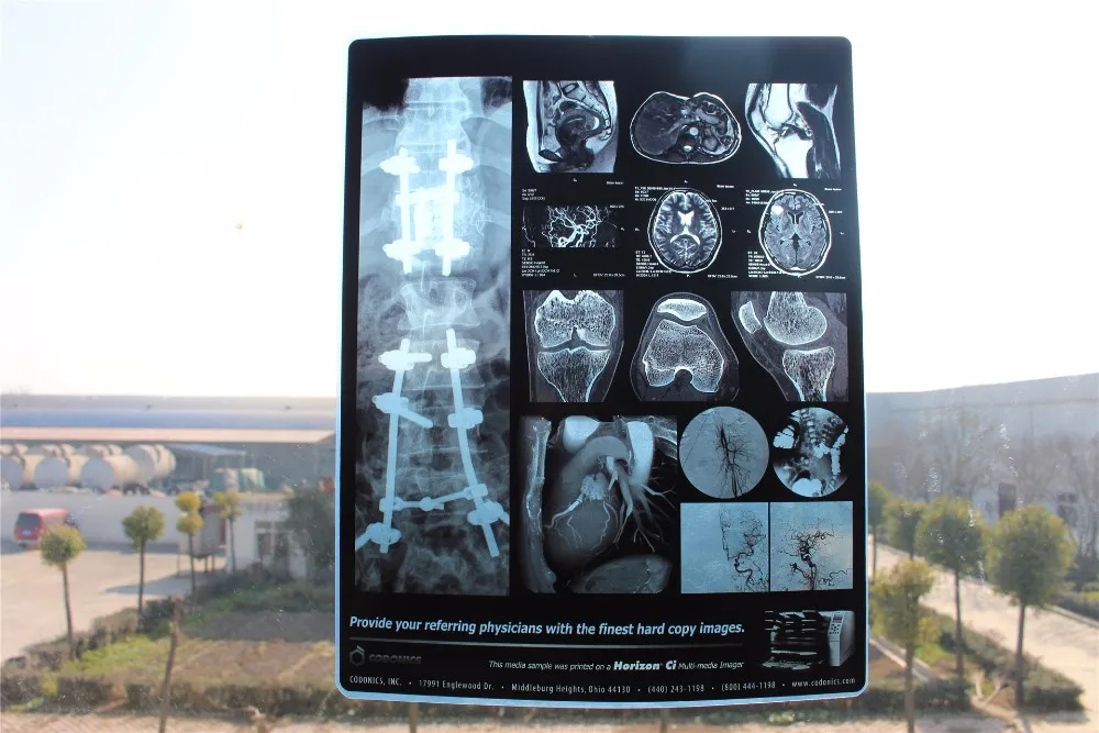 Universal Medical Blue and White Transparent Inkjet/Laser Medical Film X-ray Film