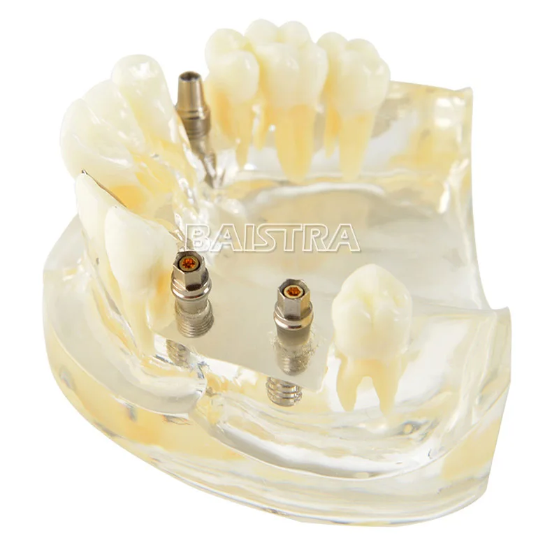 Широко используются пластиковые 4 гвоздя импланты модель зубов Модель