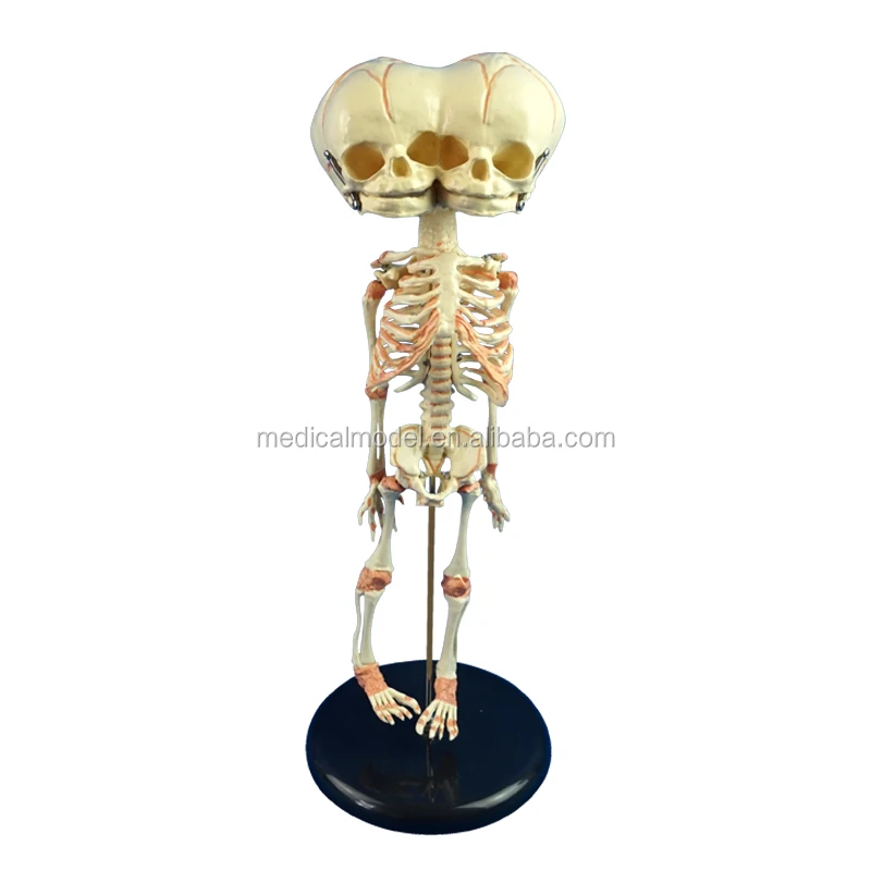 Deformed Twin Head Baby Skeleton Model 18x18x40CM Detachable Infant Anatomical for Medical School and Hospital by Skeleton King