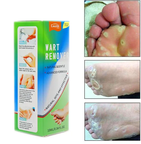 
Средство для удаления родинок, бородавок, мозолей, черных точек, 10 мл 