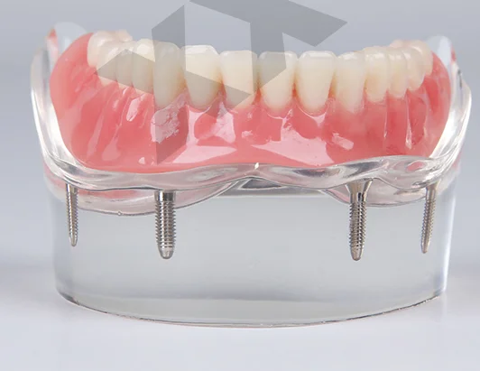 Mandibular overdenture имплантат зубов с 4