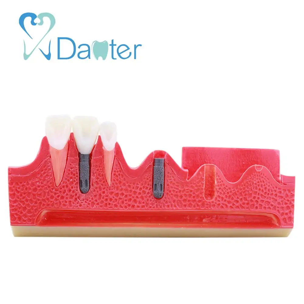 Шаг по заводской цене для имплантации стоматологической модели студенческой