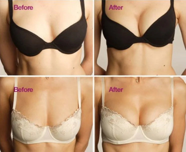 Fosyderm 20 Ml Subskin Breast And Buttocks HA Dermal Filler