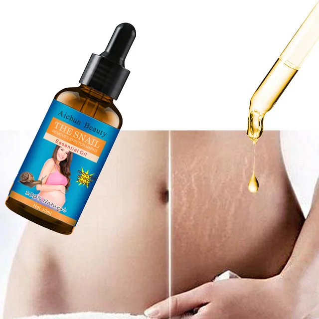 Stretch Marks Remover Essential Oil Skin Care Treatment Cream For Stretch Mark Removal Maternity Slackline For Pregnant Oils 30g Buy Removal Stretch Marks Stretch Oil Stretch Marks Remover Essential Oil Product On Alibaba Com