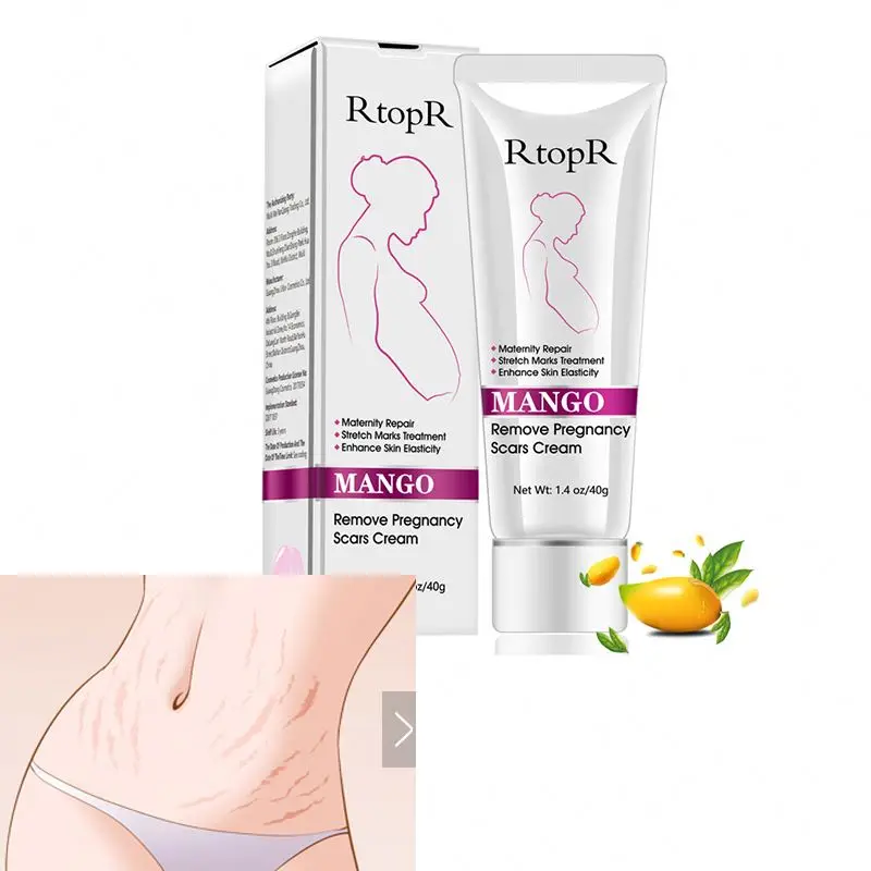 mango anti stretch mark cream