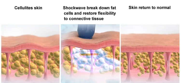 
Экстракорпоральная ударно-волновая терапия оборудование/ударно-волновая машина цена для эректильной дисфункции 