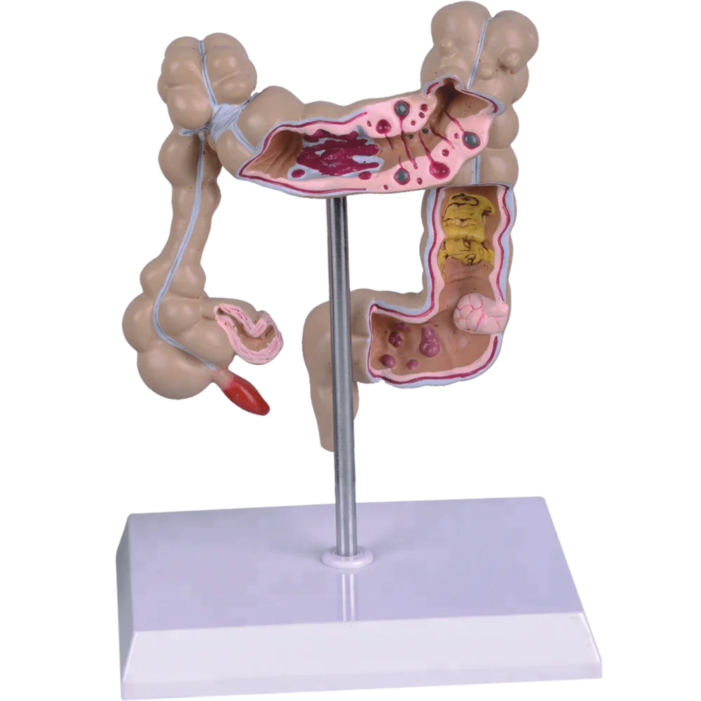 Патологическая модель. Модель легких своими руками. Патологическая модель. Медицинские муляжи с патологиями. Муляж желудка.