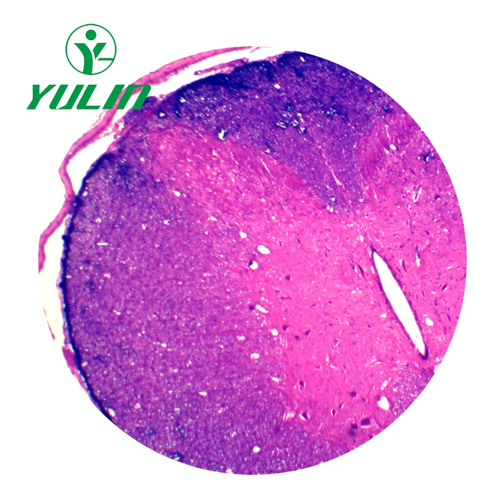 PCNSV With Spinal Cord Involvement: A 40-Year Single-Center Study | Stroke, image size:1000x1000
