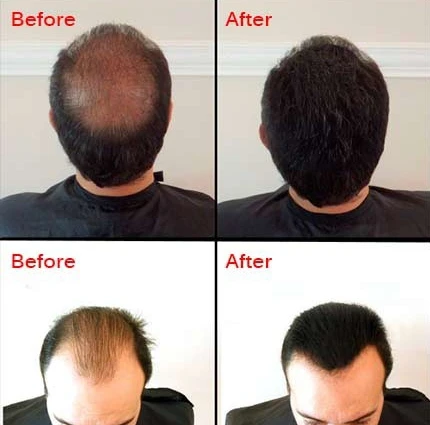 Бесплатные образцы, лосьон для роста волос Mokeru против выпадения волос для нового роста волос, 30 мл * 2, сыворотка для китайской травяной медицины