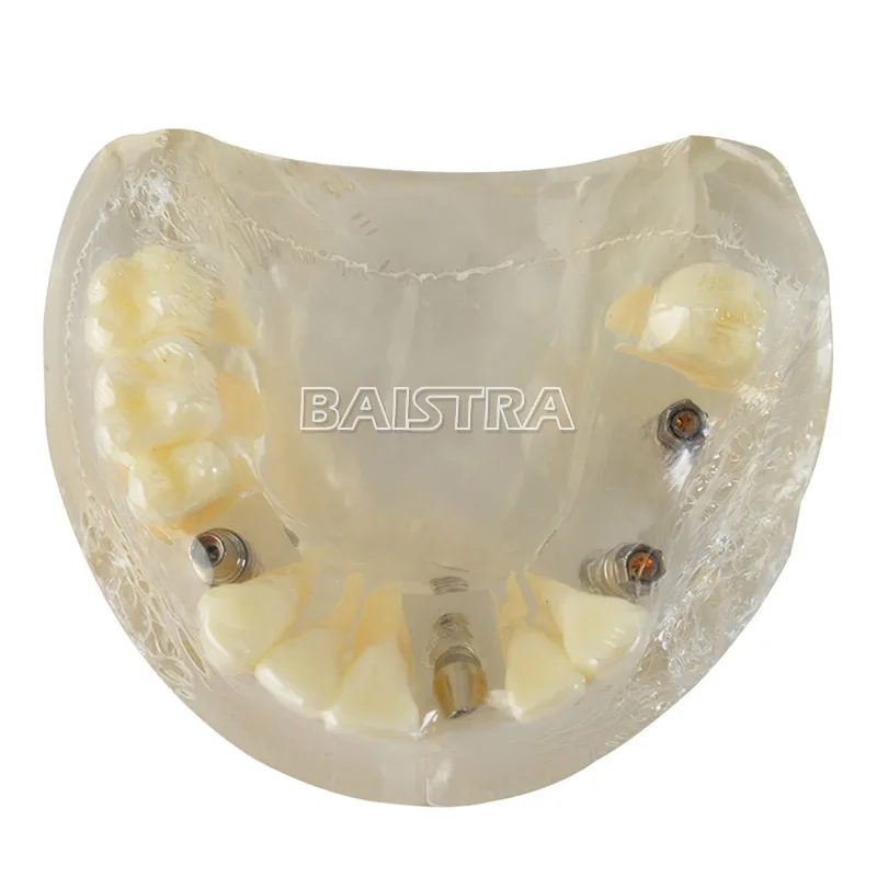 Широко используются пластиковые 4 гвоздя импланты модель зубов Модель