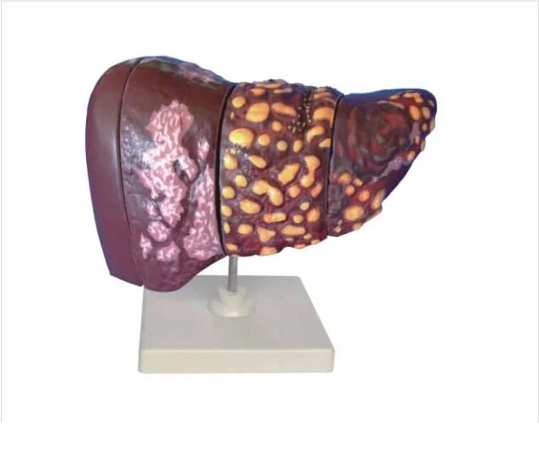 Medical Science Human Disease Liver Model Medical Teaching Model for Educational Equipment Teaching Resources