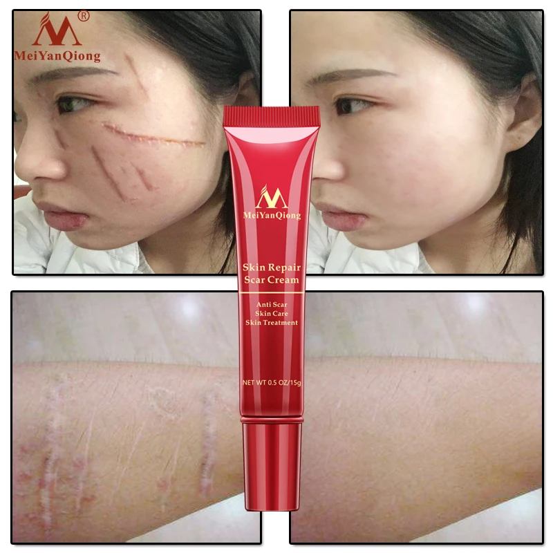 skin repair scar cream