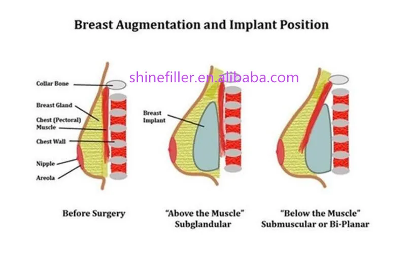 Fosyderm 20 Ml Subskin Breast And Buttocks HA Dermal Filler