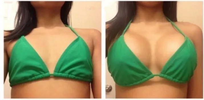 Fosyderm 20 Ml Subskin Breast And Buttocks HA Dermal Filler