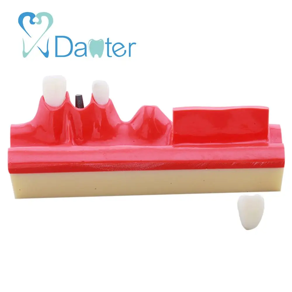 Шаг по заводской цене для имплантации стоматологической модели студенческой