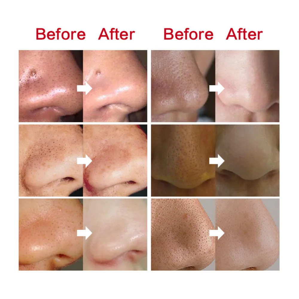 Autocollant Antipoints Noirs,Appareil Pour Enlever Les Pores Du Nez