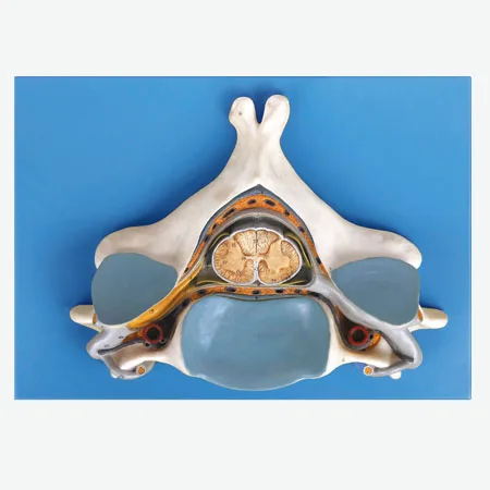 Model of Enlargement of Spinal Cord and Spinal Nerve in the Fifth Cervical Spine