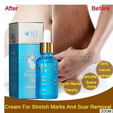 Oem Natural Best Pregnancy Stretch Mark Removal Creams For Anti Stretch Marks Cream Buy Anti Stretch Marks Cream Stretch Mark Removal Cream Whitening Spots Remove Cream Product On Alibaba Com