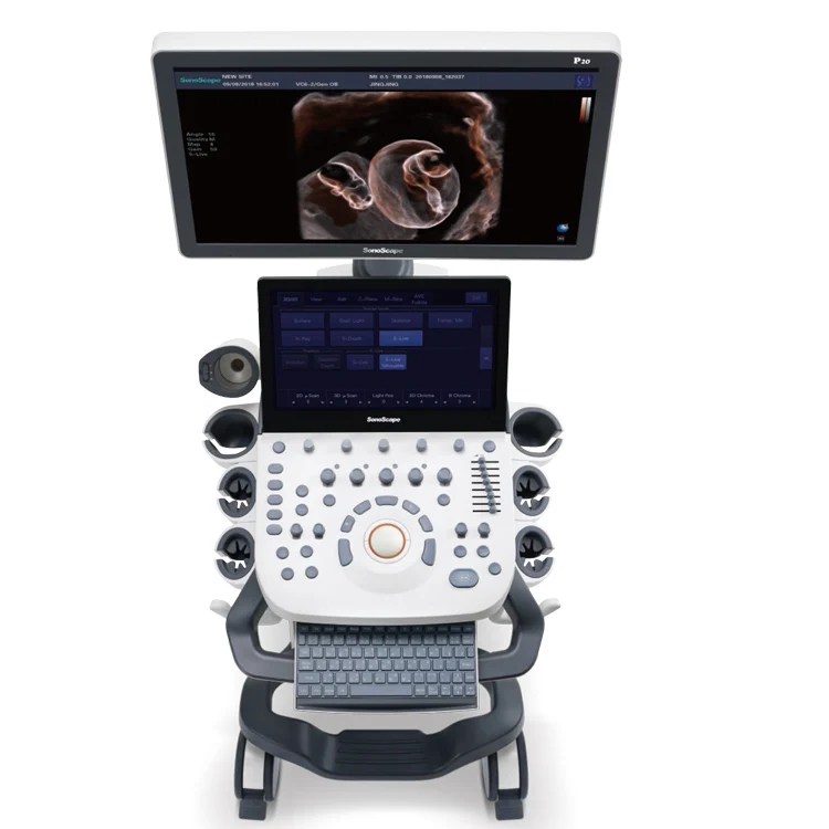 Value and Significance Sonoscape P20 Digital Color Doppler Ultrasound