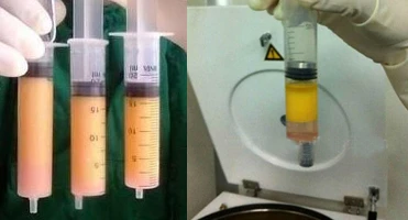 High Quality Stem Cell Fat Transfer Centrifuge for 20cc 50cc Syringes Lipo Suction Treatment Beauty Clinic Use