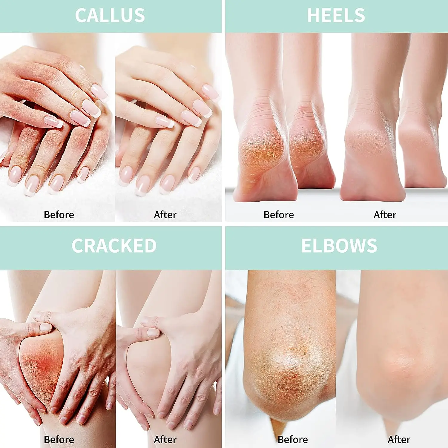 OEM Hand Foot Care Moisturizing Nourishing Removal Callus Peel Crack 2% Salicylic Acid Urea 40%  Cream