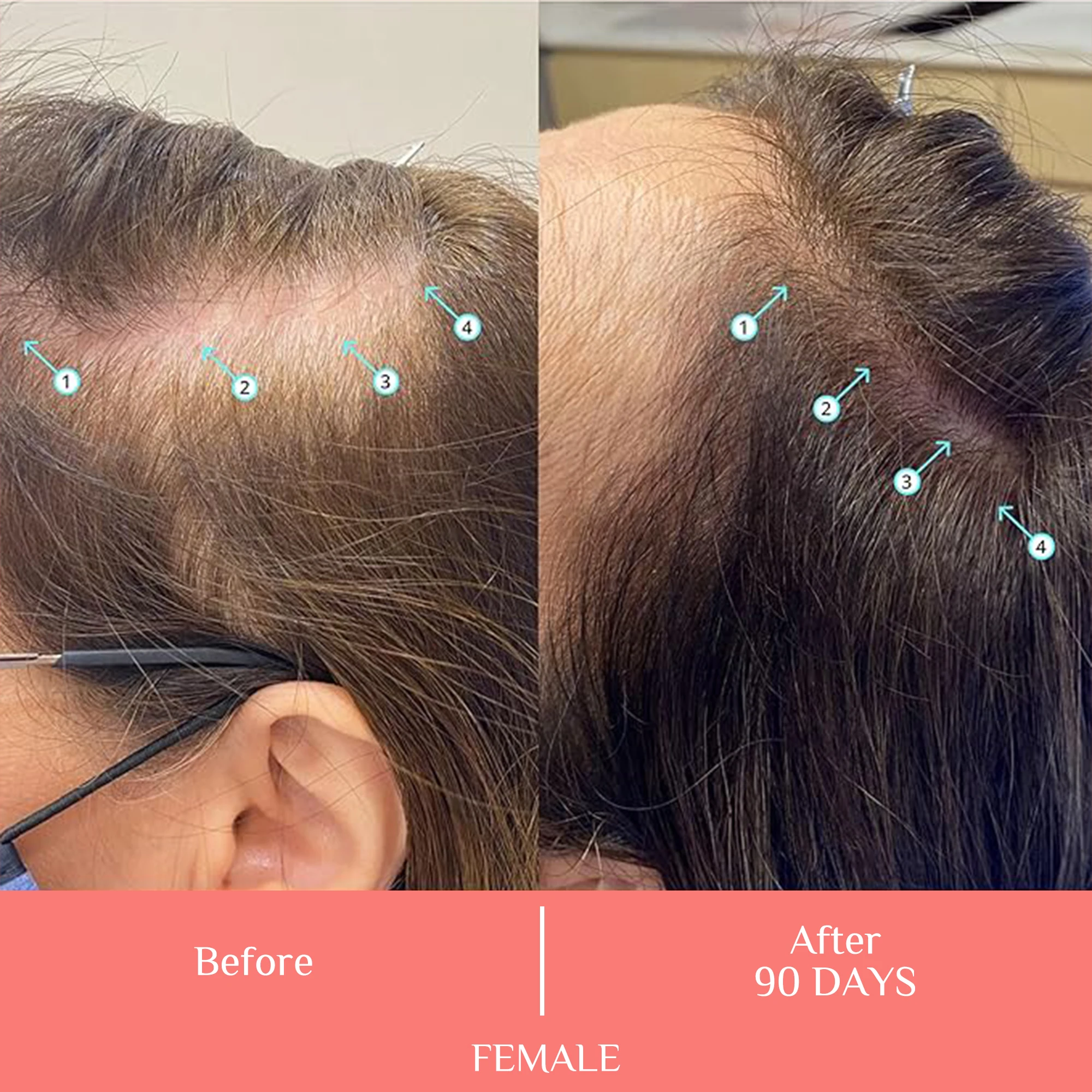 Organic Scalp Revitalizing Spray with Amino Acids & Hyaluronic Acid for Hair Follicle Stimulation and Growth