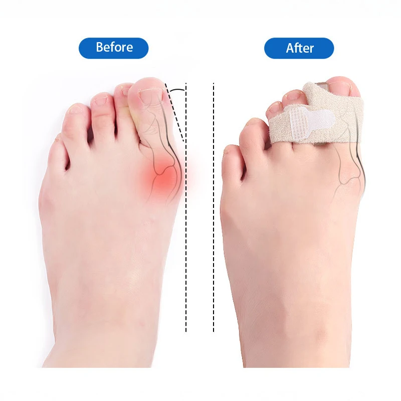 Elastic Hallux Valgus Bunion Splint Big Toe Strap Heal Wrap Toe Straighteners for Crooked Toes Hammer Separators