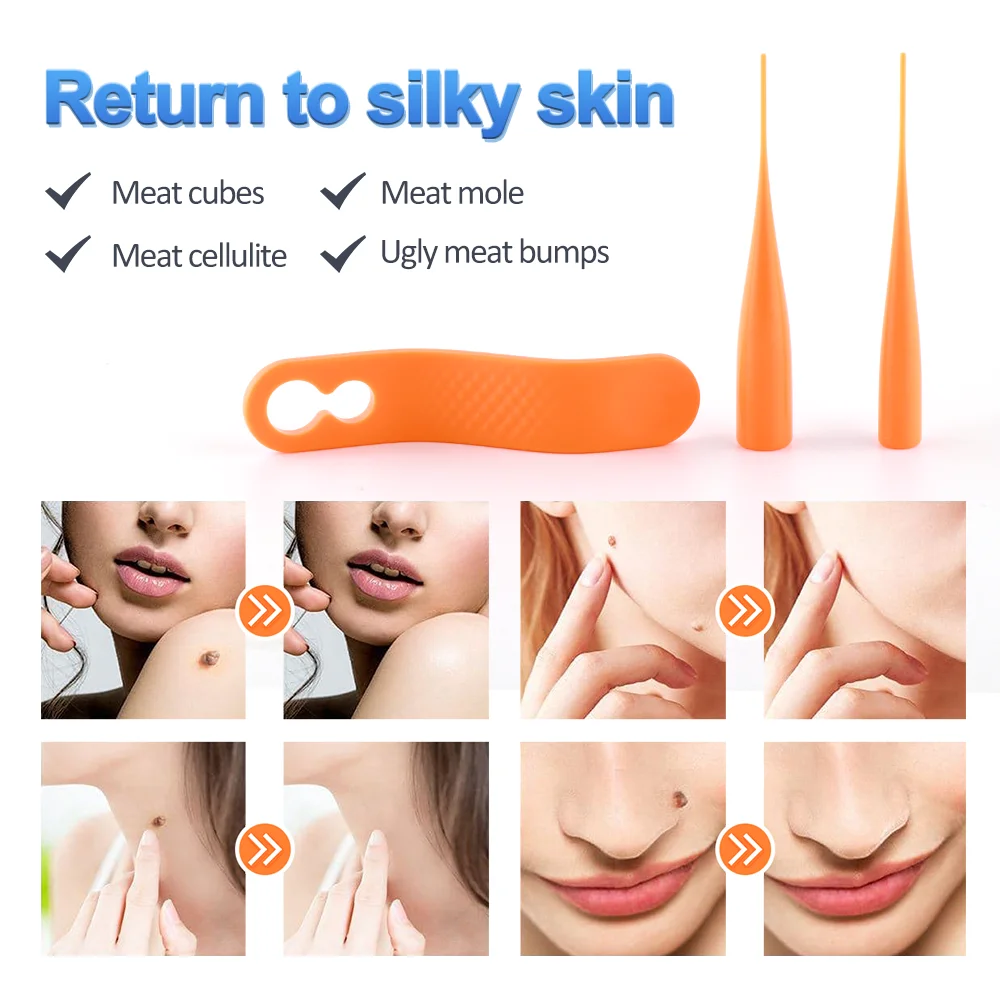 Skin Mole Wart Remover Skin Tag Removal Kit With Cleansing Swabs Adult Mole  Wart Face Care Skin Tag Remover - Buy Skin Tag Remover,Skin Mole Remover,Skin  Tag Remover Kit Product on Alibaba.com