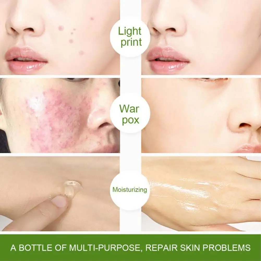 Organic Pure Aloe Vera Gel for Sunburn, Anti-Acne & Razor Bumps | Hydrating  Moisture for All Skin Types