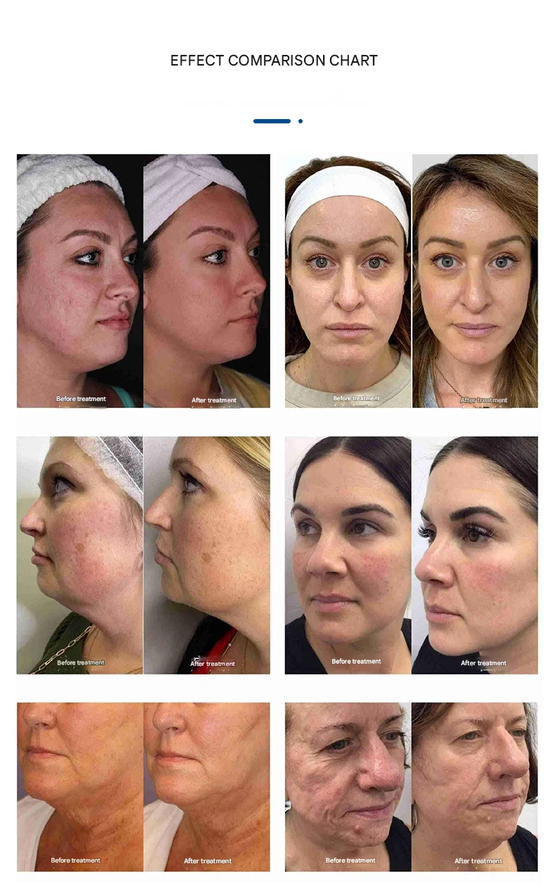 RF Microneedle 40pin Needle Skin Tighten Wrinkle Remove Machine Rf Microneedling Device Microneedling Rf Fractional Resurfacing