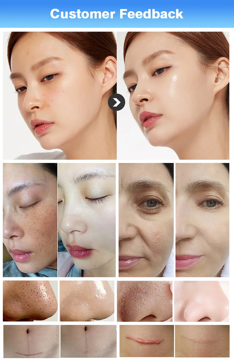 New water dermabrasion /Hydra Diamond Microdermabrasion machine/spa facial cleaning 3