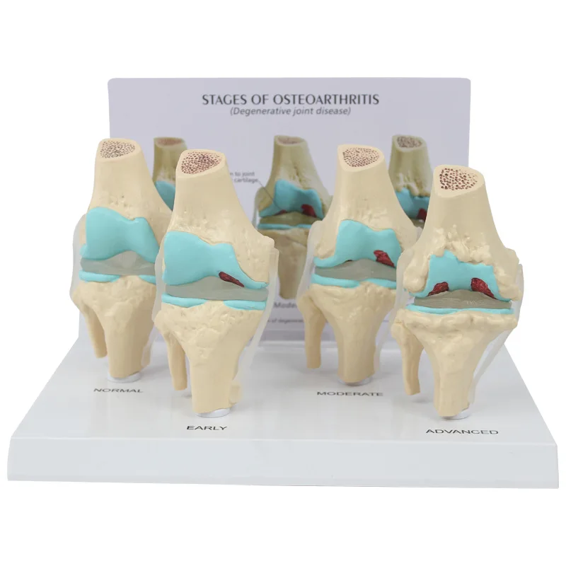 4 Stage Knee Joint Disease Model - Anatomy Teaching Tool
