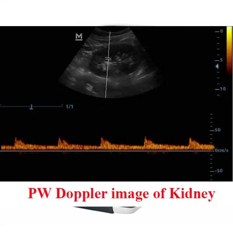 Mindray DP-20 Medical Full Digital Ultrasound Scanner Price 3d 4d Portable Ultrasound Machine