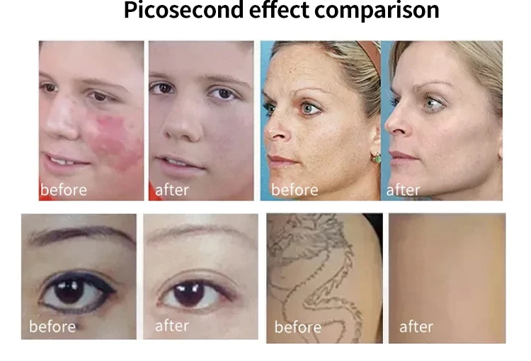 Good PriceLaser Hair Removal Machine Diode Laser  Best Feedback 2 In 1 1064nm Permanent Diode Laser Hair Removal  Machine