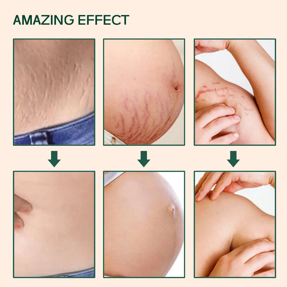 Strong Effective Stretch Mark Removal Oil Scar Remover Body Pregnancy