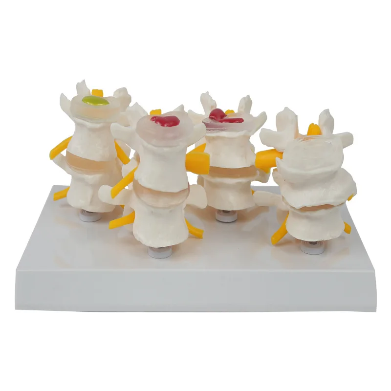 Medical Science Human Pathological Lumbar Spine Model 4 Stage Real ...