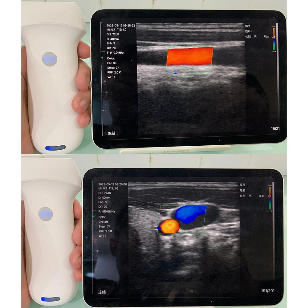 Suresult Usb Phased Array With Double Head Handheld Color Doppler Wireless Convex Linear Cardiac