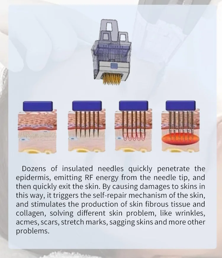 Discover a clinical-grade Microneedling RF System engineered for deep dermal remodeling, collagen stimulation, acne scar reduction, and skin tightening. Adjustable depth up to 7mm with precision RF delivery. Professional Fractional RF Microneedling Machine For Sale